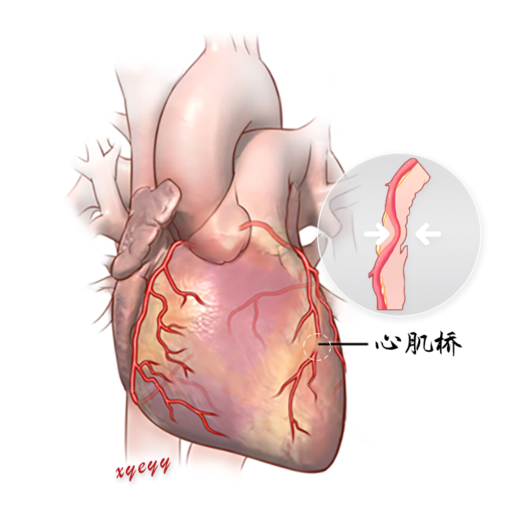 心肌桥的最新治疗,心肌桥治疗新进展