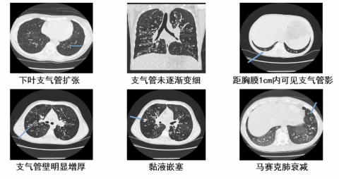 支扩最新研究-支扩前沿动态